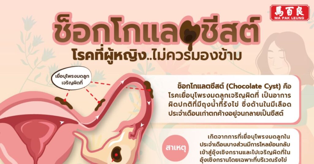 ช็อกโกแลตชีสต์ โรคที่ผู้หญิงที่ไม่ควรมองข้าม (โอวกิมอี้)