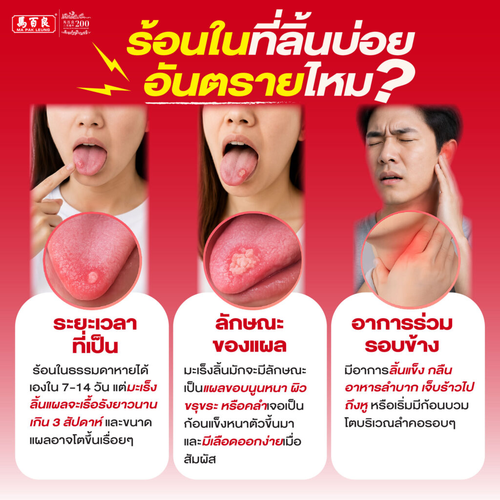 เป็นร้อนในที่ลิ้นบ่อย ๆ สัญญาณเตือน โรคมะเร็งลิ้น ! 3 ร้อนในที่ลิ้นบ่อย อันตรายไหม? ภาพอนโฟกราฟฟิคอธิบาย เรื่องร้อนในที่ลิ้น มีระยะเวลาที่เป็น ลักษณะของแผล พร้อมอาการร่วมรอบข้างอธิบายในรูป