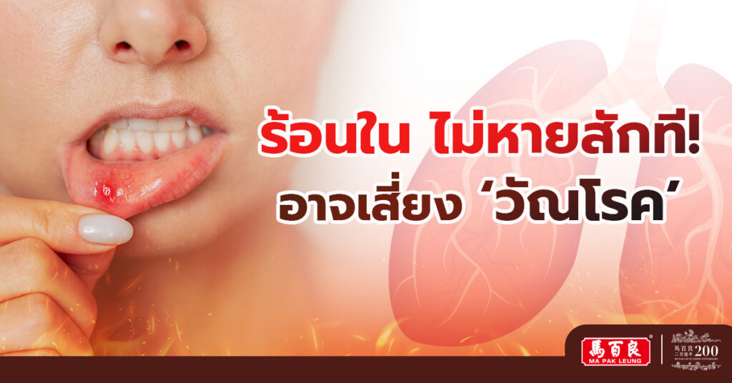ร้อนในไม่หายสักที! เป็นร้อนในเรื้อรังอาจเสี่ยง ’วัณโรค’