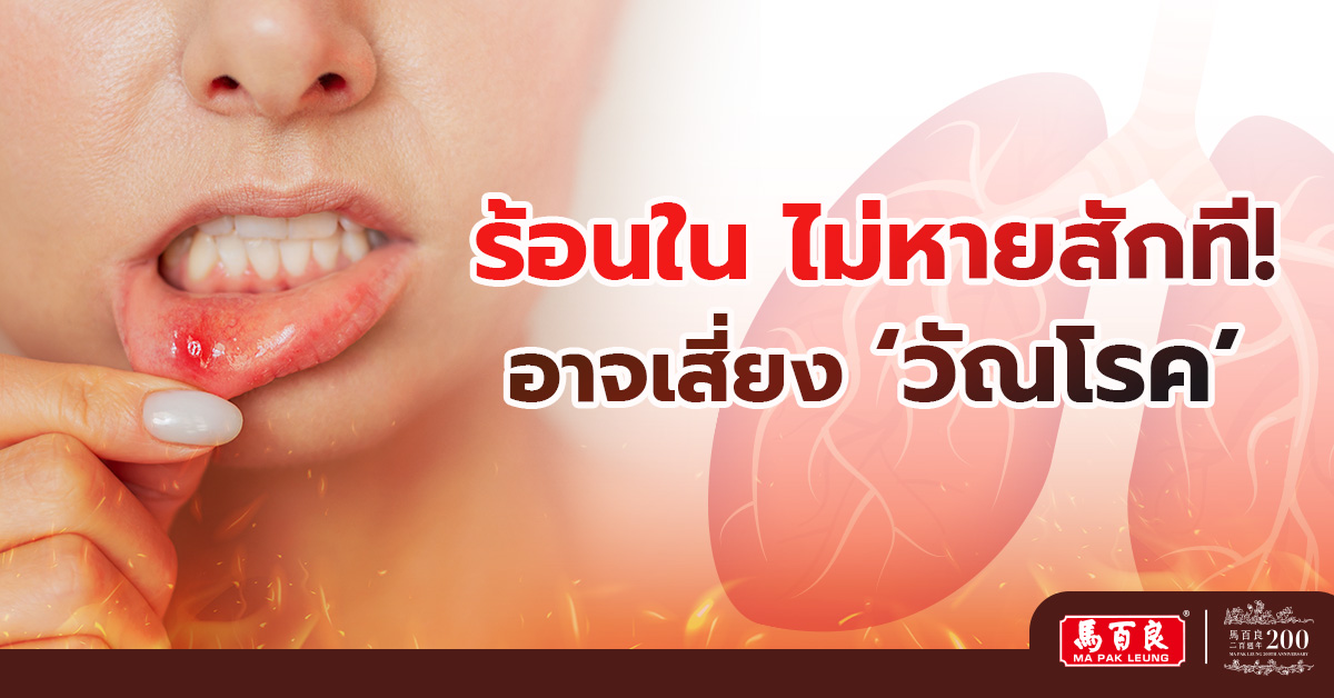 ร้อนในไม่หายสักที! เป็นร้อนในเรื้อรังอาจเสี่ยง ’วัณโรค’